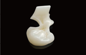 CERLEAD inlay and onlay — minimally invasive posterior restoration